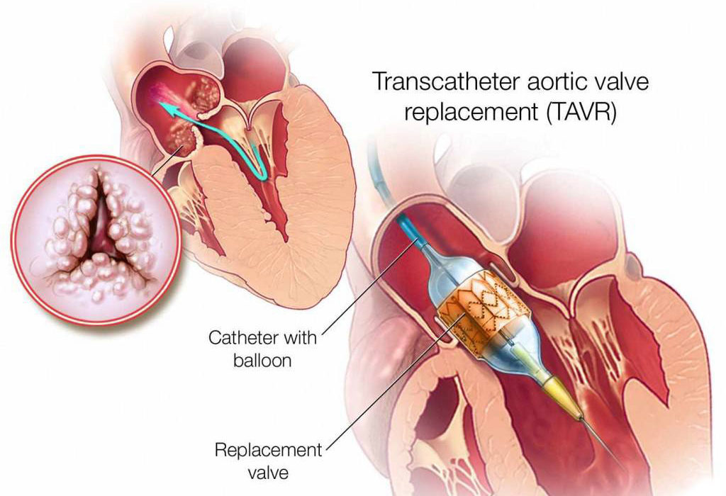 tavr-post