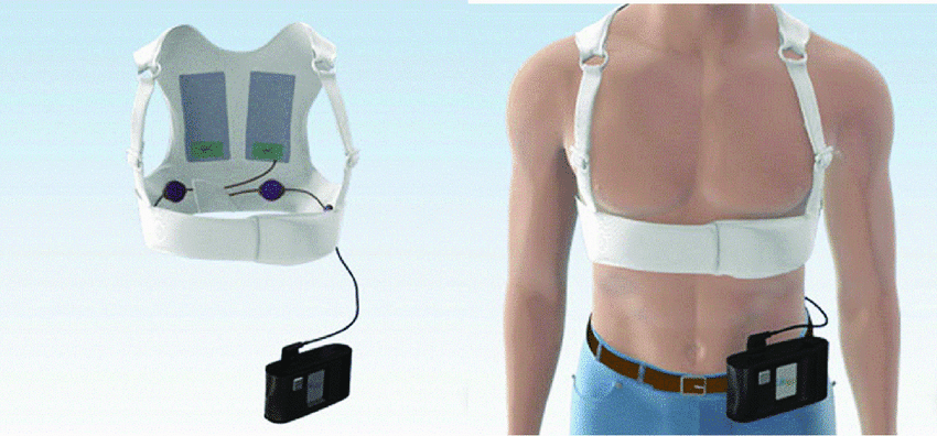 Wearable-cardioverter-defibrillator