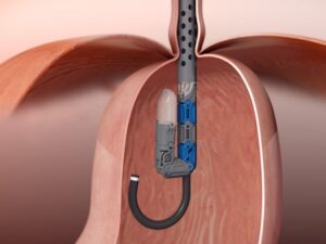 gerd-tech-options-treatment