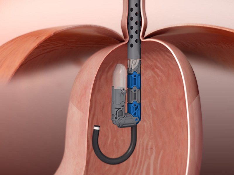 gerd-tech-options-treatment