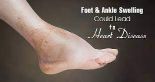 heart failure feet swelling