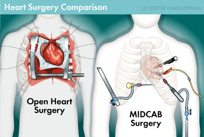 Minimally-Invasive-Aortic-Valve-Surgery-0000